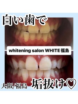ホワイトニングサロン ホワイト(WHITE)/白い歯で垢抜け