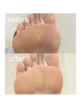フットケアでつるつるの足裏に