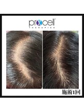 ヒルナム(Heal Nam)/プロセルセラピーズ　~頭皮~