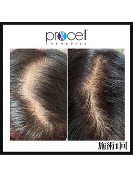 ヒルナム(Heal Nam)/プロセルセラピーズ　~頭皮~