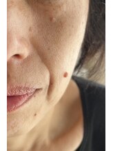 ピュアージュ/神業エイジング▼ほうれい線/前