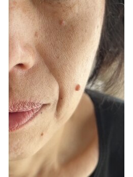 ピュアージュ/神業エイジング▼ほうれい線/前