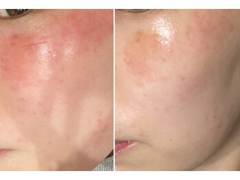 コルギ デ コガオ(KORUGI de KOGAO)/【業界初スペック】LED&IRエステ