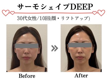 スパイア(SPIRE)/サーモシェイプdeep★顔