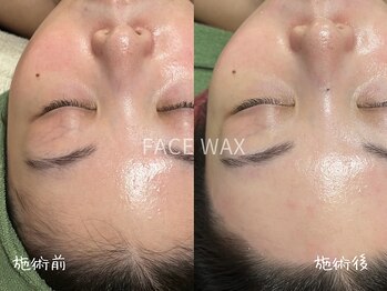ミコサロン(miko salon)/フェイスワックス