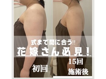 ミセル(MISEL2nd)/隠さないドレス専用ボディケア★