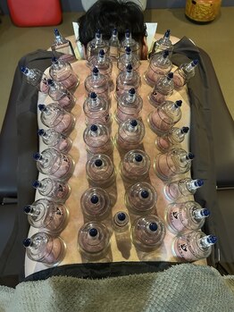 柔整 おがわ屋/カッピング