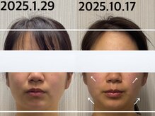 ベール(BEHL)/コルギのBeforeAfter