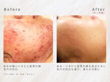 メレ(mele)/20代ニキビケア／毛穴