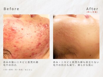 メレ(mele)/20代ニキビケア/毛穴