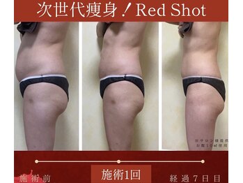 ザ サロン 726(THE SALON 726)の写真/短期集中コースで結果を出していきます！脂肪分解レモンボトルの進化版！痩身を促す成分が増量美肌ケアも◎
