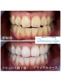 ホワイトニングサロン 熊本店/黄ばみがとれるホワイトニング