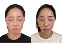 けいのき鍼灸整骨院/美容鍼3ヵ月8回の効果！美容鍼灸