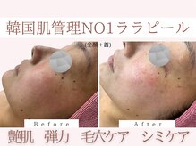 Cスキンケアクリニック 麻布店/ララピールBeforeAfter#乾燥