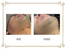 エコム(ECOM)/青ヒゲ撃退！