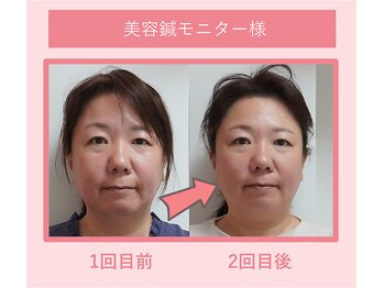 グリーンノア鍼灸院/40代女性美容鍼1-2回目の変化