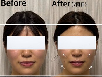 ベール(BEHL)/コルギのBeforeAfter