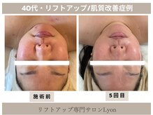 リヨン(Lyon)/（40代）全身の浮腫み・肌質改善