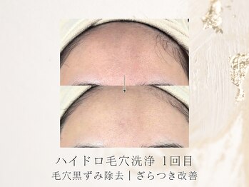 アネラボーテ(Anela Beaute)/毛穴大掃除コース