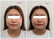ぶんご整骨院 下郡院の雰囲気（電気ハリネズミ+ヘッドマッサージbefore &after）