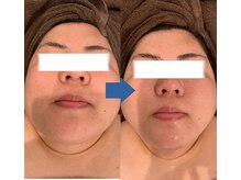 ピュアトゥルー 岐阜西店(PureTrue)/輪郭スッキリ！