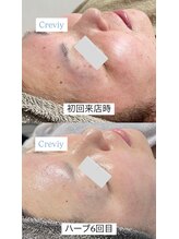 クレヴィー(Creviy)/陶肌トリートメント6回経過