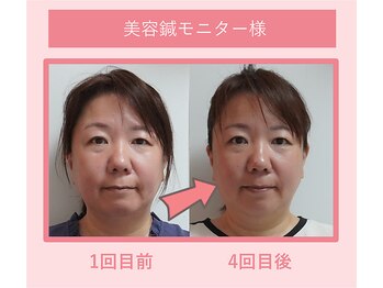 グリーンノア鍼灸院/40代女性美容鍼1-4回目の変化