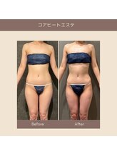 エクラ(ECLAT)/コアヒート痩身