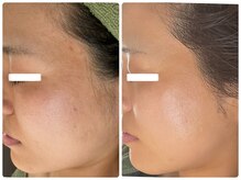 ルミエール フォレストサイド(L’MIERE forestside)の雰囲気（毛穴縮小◎毛穴ケアを続けていくと約半年で凹凸肌荒れ跡も改善）