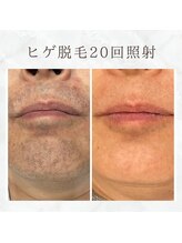 ボゴス(BOGOSS)/ヒゲ20回照射