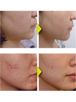 アンベリ(Embelli)/