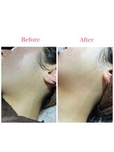 リエット(Lieto)/顔まわり脱毛！！