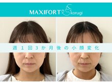 コルギ専門店 マキシフォート 栄店(Maxifort)/週1回3ヶ月後の小顔変化