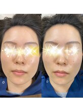 ヤマグチ美容整体院/大人気の美容鍼♪