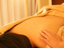 ハリ パール(HARI PEARL)/全身美容鍼灸/コリ解消　背中