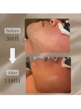 ネイチャー(Nature)/【ヒゲ脱毛BeforeAfter】