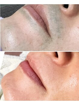 サロン ベル(Salon B'elle)/メンズ髭脱毛