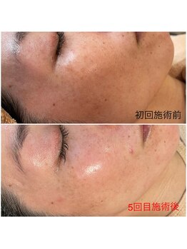 ピュール 鯖江店(PUR)/肌質改善/光フェイシャル