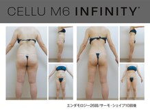 ビューティーリバース センター北店/エンダモロジーインフィニティ