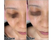 ベルミーランド マルエツ安行慈林の雰囲気（フェイシャルエステダーマ施術前→施術後）