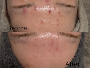 ルミライズ(lumirise)/〈8回目での効果〉