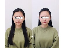 美助(bisuke)/小顔施術１回のお写真