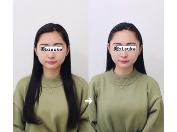 美助(bisuke)/小顔施術１回のお写真