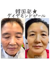 癒える(ielu)/韓国発★ダイヤモンドピール