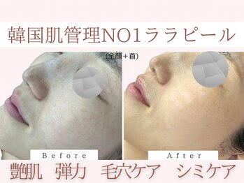 Cスキンケアクリニック 麻布店/ララピールBeforeAfter#乾燥