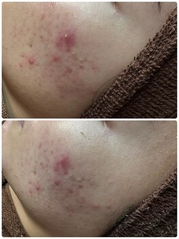 アレーズファイブフォー(A’LAISE54)/ニキビケア