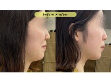 エヴァ ナゴヤ(EVA nagoya)/あご下のたるみ