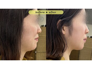 エヴァ ナゴヤ(EVA nagoya)/あご下のたるみ