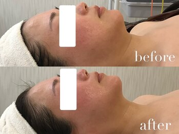 上野エステサロン レア(Lea)/今話題の小顔レモンボトル