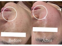 リネ(Rine)/毛穴引き締め！リフトアップ！